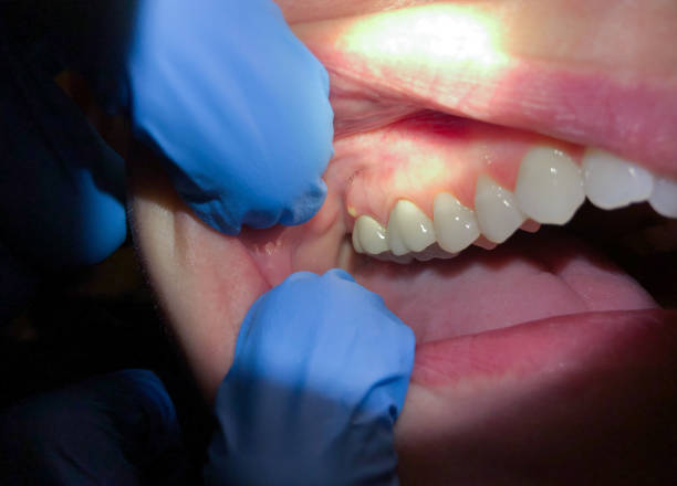 Best Emergency Wisdom Tooth Extraction in Emerson, GA